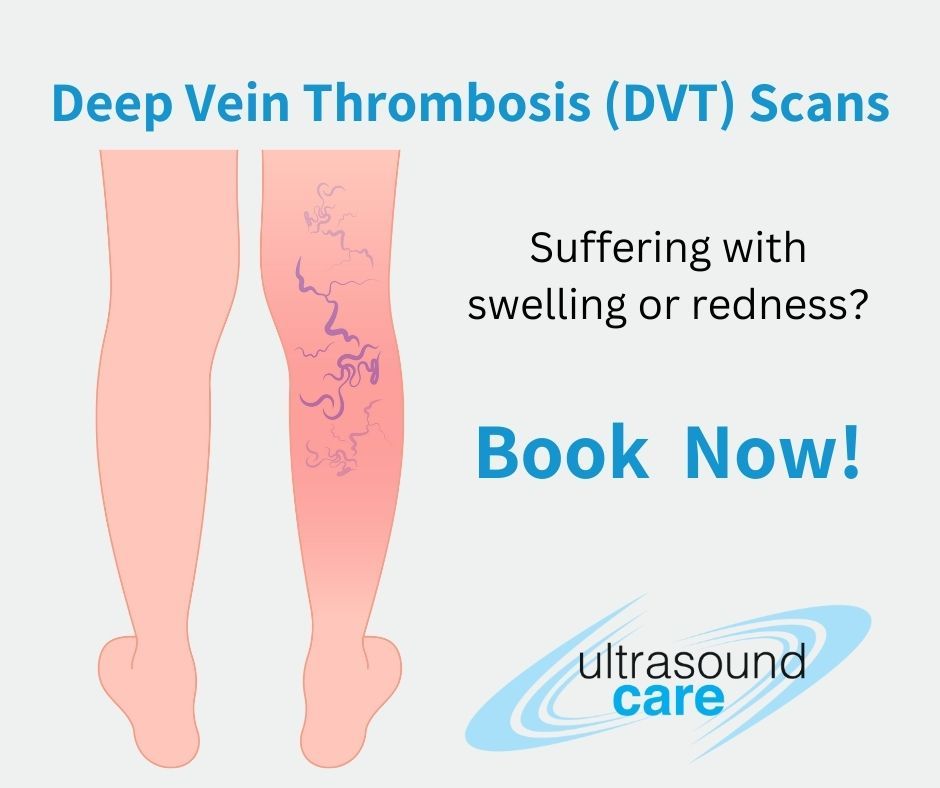 DVT Scans blog, DVT image with symptoms and book now